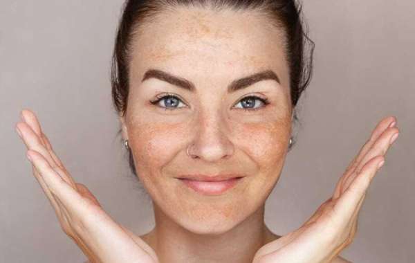 Melasma and Lifestyle Adjustments