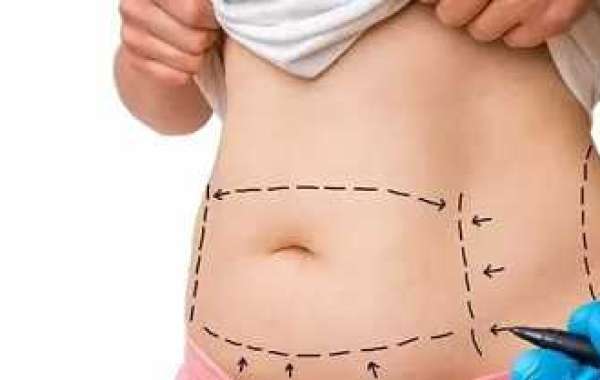 Best Clinic for Liposuction in Islamabad – How to Choose Wisely