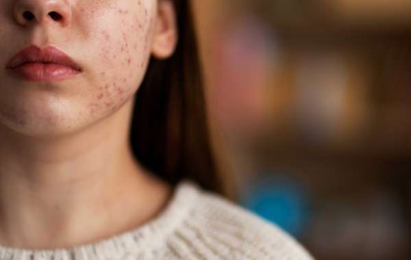 Types of Acne Scars and Their Treatment Options in Jayanagar