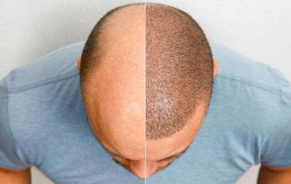 The Complete Guide to Budget-Friendly Hair Transplant Solutions in Riyadh