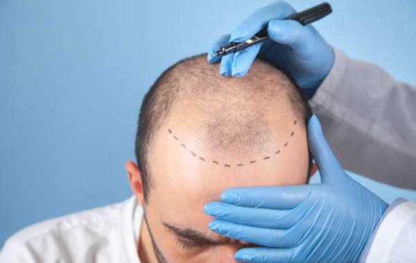 Hair Transplant Myths About Instant Results Debunked Clearly