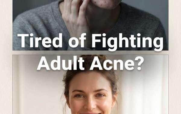 Clearer Skin, Calmer Confidence: A Modern Approach to Acne Treatment That Lasts