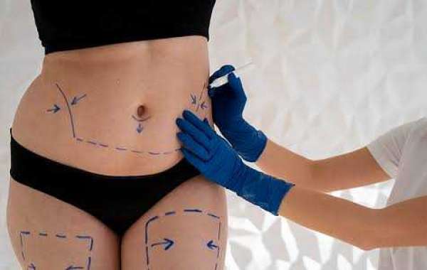 Modern Tummy Tuck in Dubai: Smooth & Firm Skin