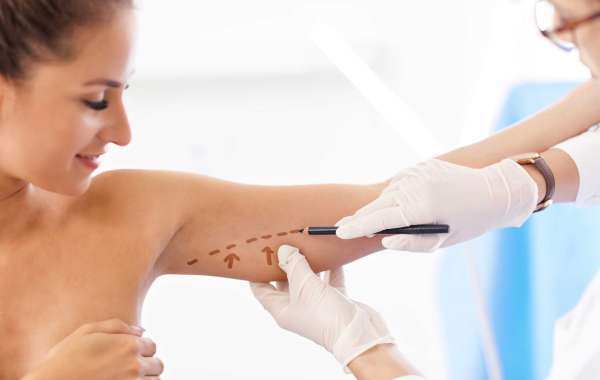 Sculpted, Renewed Confidence Begins with Arm Lift Surgery