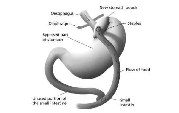 Healthy Snacks After Gastric Bypass Surgery for Weight Loss