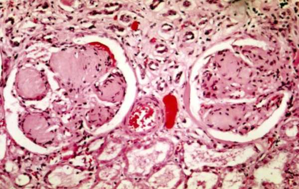 What Are the Symptoms of Focal Segmental Glomerulosclerosis and How Is FSGS Treated?