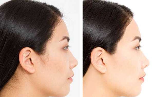 What Should a Hiko Nose Lift Price Quote Include?