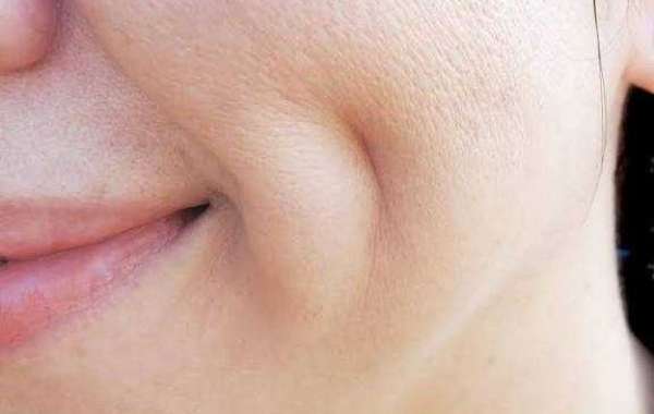 Add Natural Charm to Your Face with Dimple Creation Surgery