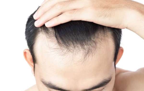 When May Hair Transplant in Dubai Be Considered?