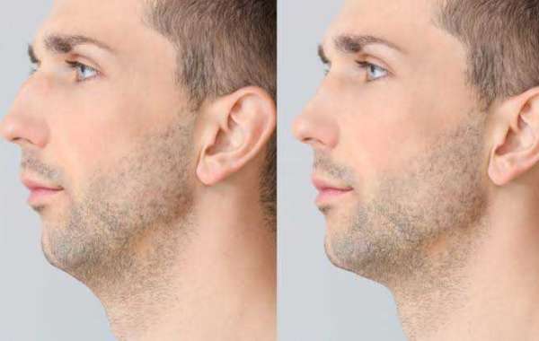 Does the Season Matter When Planning Male Rhinoplasty in Islamabad?