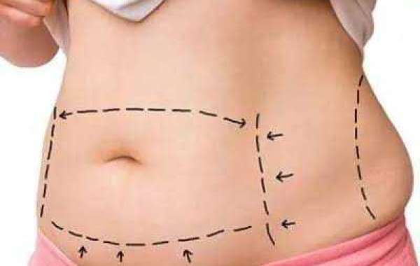 When Will I See Final Results After Fat Transfer Treatment in Islamabad?