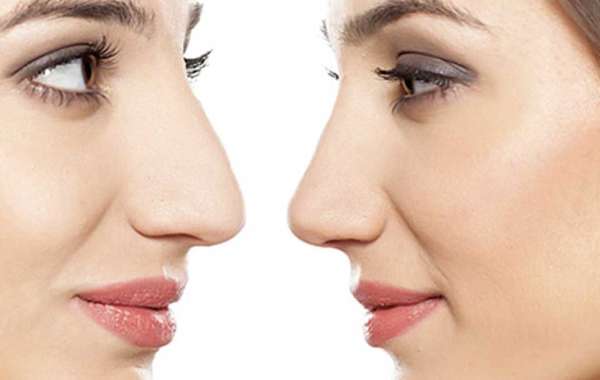 Will My Nose Look Natural After Rhinoplasty in Islamabad?