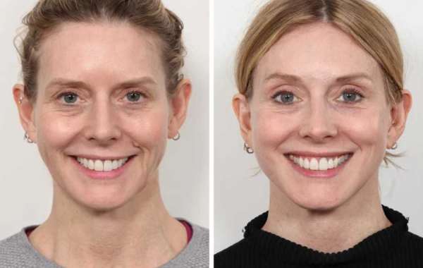 Best Plastic Surgeon in Dubai for Thread Lift and Face Contouring