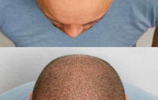 The Growing Popularity of Hair Transplant Surgery