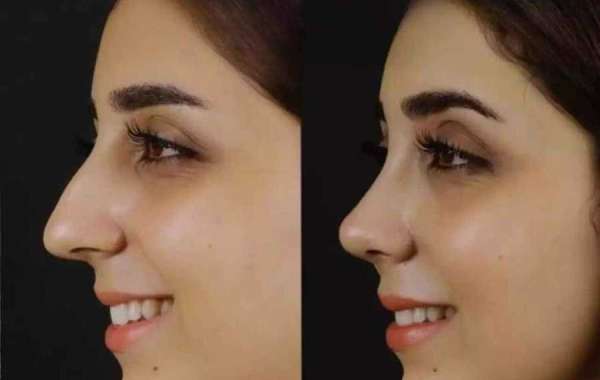 Can Nose Deviated Septum Surgery in Dubai Reduce Nasal Blockage?