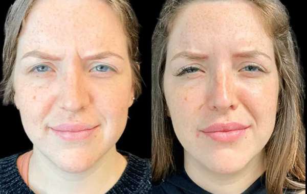 Best Aesthetic Clinics in dubai for Botox Consultation and Preparation
