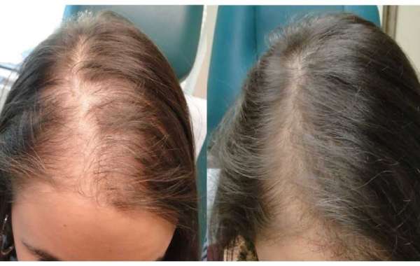 Can Stress Make Women Lose Their Hair?