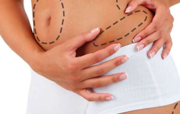 What Type of Anesthesia Is Used for Liposuction in Islamabad?