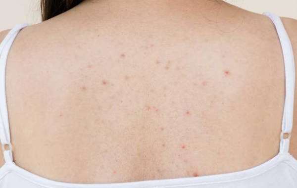 How to Manage Persistent Back Acne Without Irritating Your Skin