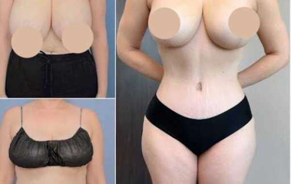 Best Tummy Tuck Surgeon in Dubai for Personalized Cosmetic Surgery Solutions