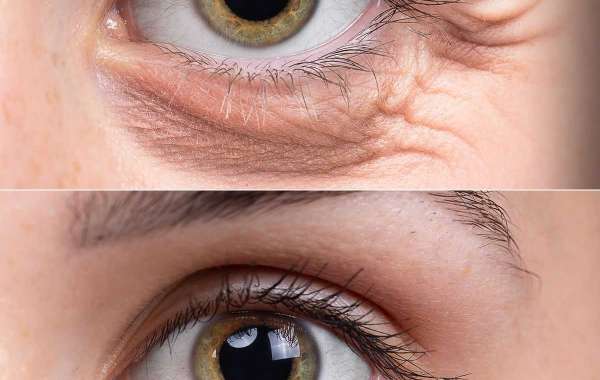 Eye Bag Removal: Understanding the Treatment Process