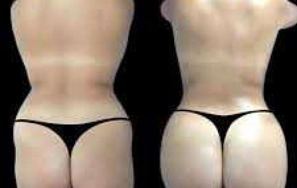 Butt Fat Transfer in Dubai: How Surgeons Prepare Fat for Injection
